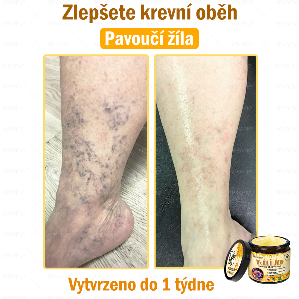 🐝Dermatologicky a klinicky testováno👩‍⚕️🐝APK®Bee Venom Krém na obnovení pleti🐝 pomáhá při léčbě kožních problémů, jako jsou: vrásky, jizvy, pigmentové skvrny, strie, akné, psoriáza, ekzém, kožní změny, podráždění, záněty a další kožní problémy.