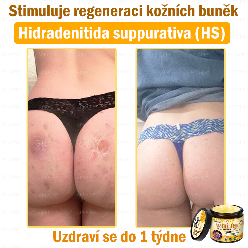 🐝Dermatologicky a klinicky testováno👩‍⚕️🐝APK®Bee Venom Krém na obnovení pleti🐝 pomáhá při léčbě kožních problémů, jako jsou: vrásky, jizvy, pigmentové skvrny, strie, akné, psoriáza, ekzém, kožní změny, podráždění, záněty a další kožní problémy.