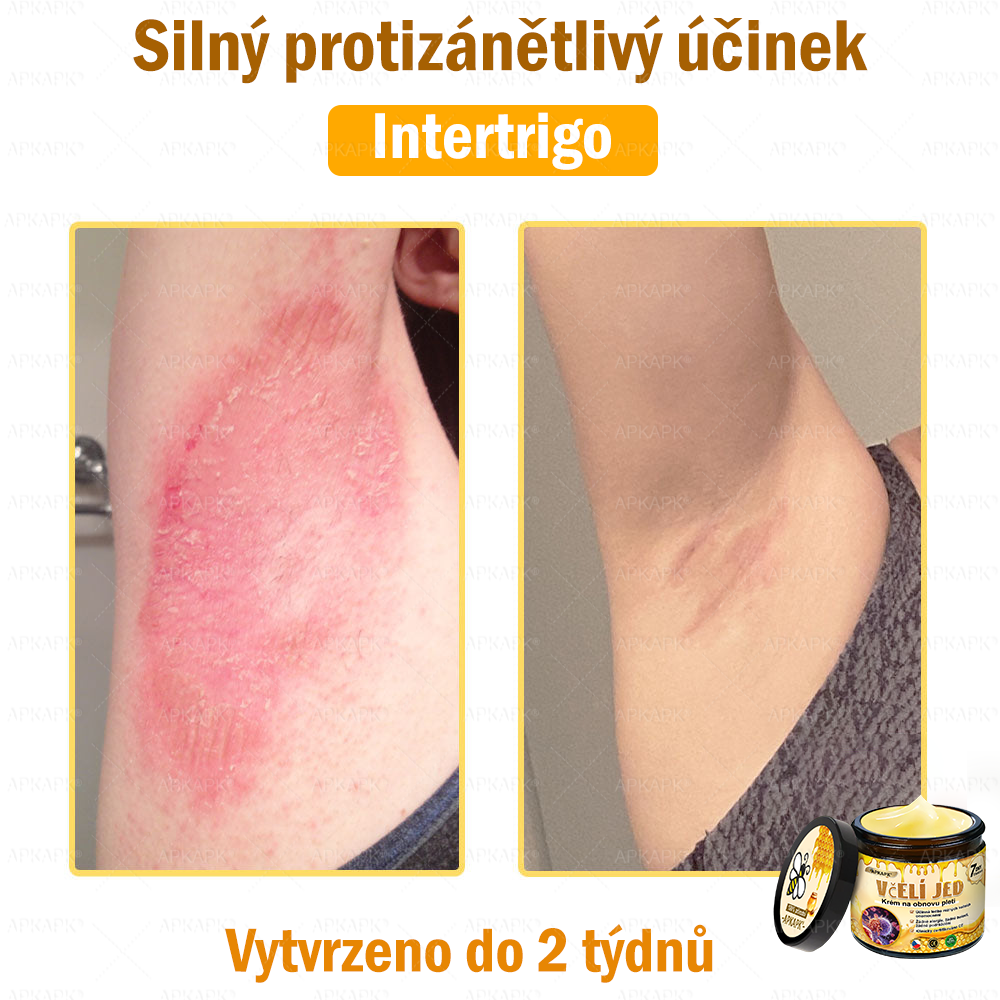 🐝Dermatologicky a klinicky testováno👩‍⚕️🐝APK®Bee Venom Krém na obnovení pleti🐝 pomáhá při léčbě kožních problémů, jako jsou: vrásky, jizvy, pigmentové skvrny, strie, akné, psoriáza, ekzém, kožní změny, podráždění, záněty a další kožní problémy.