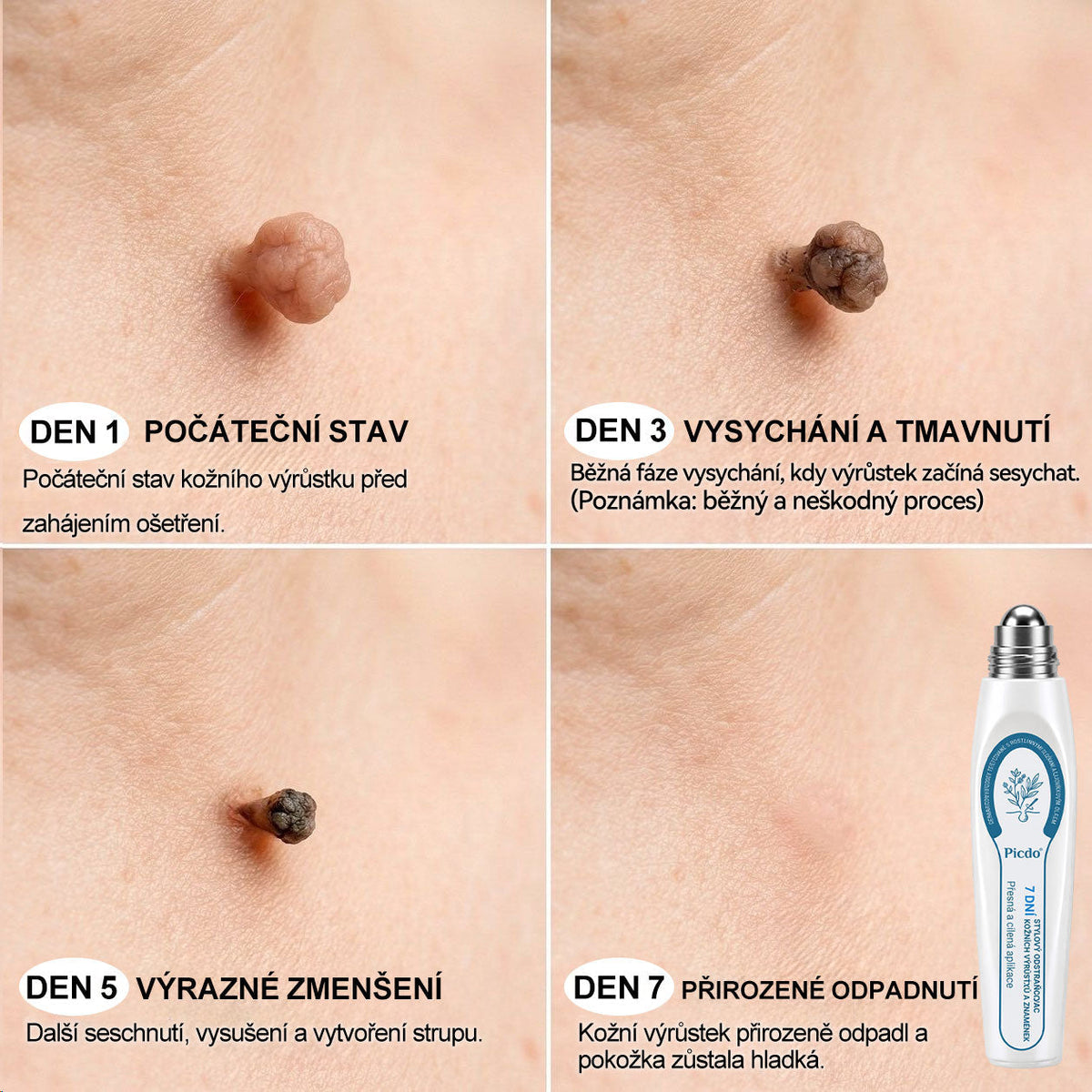 Oficiální značkový obchod🌷🌷 |🖊️𝐏𝐢𝐜𝑑𝑜® 𝟩𝖽𝖾𝗻𝗻í 𝘰𝘥𝘴𝘵𝗋𝖺ň𝗈𝗏𝖺č 𝒔𝒌𝒗𝒓𝙣 𝙖 𝙥𝙞𝙜𝙢𝙚𝙣𝙩𝘰𝘷ý𝘤𝘩 𝘴𝘬𝖛𝖗𝖓 (Bezbolestný rollerball bez jizev)