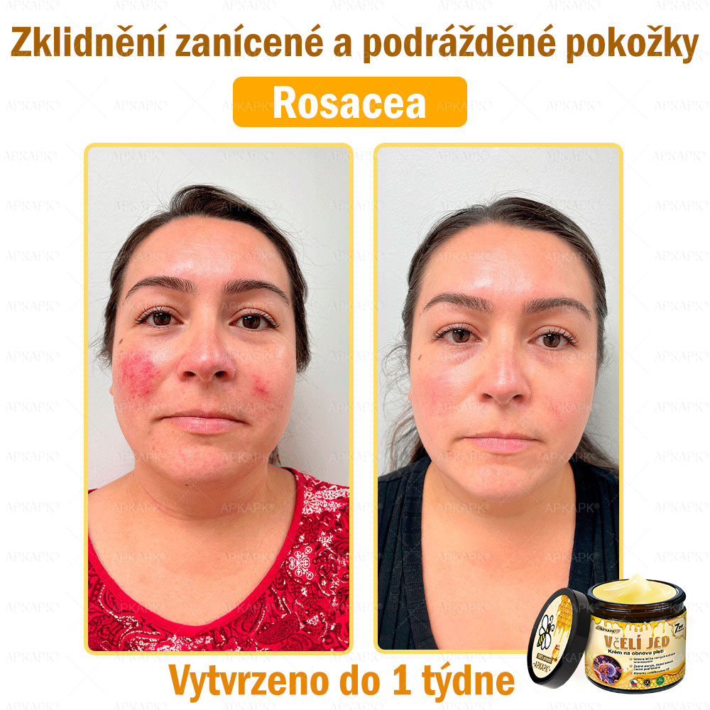 🐝Dermatologicky a klinicky testováno👩‍⚕️🐝APK®Bee Venom Krém na obnovení pleti🐝 pomáhá při léčbě kožních problémů, jako jsou: vrásky, jizvy, pigmentové skvrny, strie, akné, psoriáza, ekzém, kožní změny, podráždění, záněty a další kožní problémy.