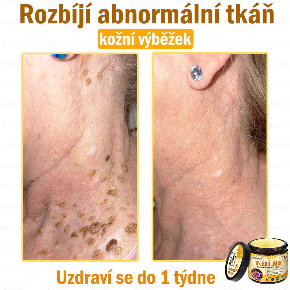 🐝Dermatologicky a klinicky testováno👩‍⚕️🐝APK®Bee Venom Krém na obnovení pleti🐝 pomáhá při léčbě kožních problémů, jako jsou: vrásky, jizvy, pigmentové skvrny, strie, akné, psoriáza, ekzém, kožní změny, podráždění, záněty a další kožní problémy.