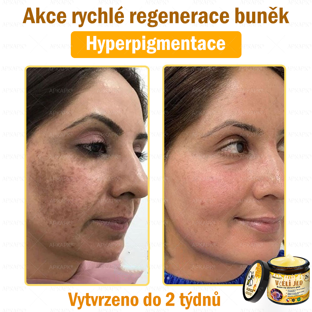 🐝Dermatologicky a klinicky testováno👩‍⚕️🐝APK®Bee Venom Krém na obnovení pleti🐝 pomáhá při léčbě kožních problémů, jako jsou: vrásky, jizvy, pigmentové skvrny, strie, akné, psoriáza, ekzém, kožní změny, podráždění, záněty a další kožní problémy.